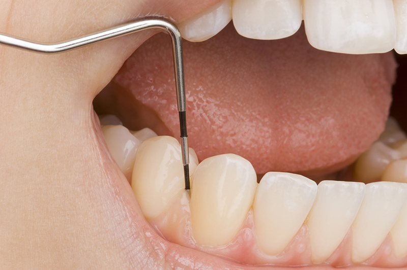 歯科医が歯周病を診断する方法